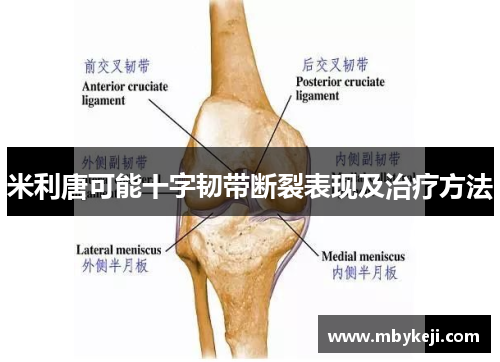 米利唐可能十字韧带断裂表现及治疗方法
